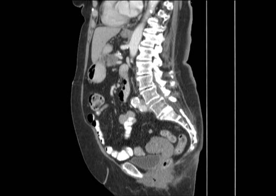 Bicameral celiacomesenteric aneurysm (Radiopaedia 55766-62327 B 32).jpg