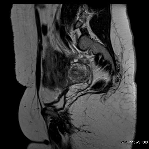 File:Bicornuate uterus- on MRI (Radiopaedia 49206-54297 Sagittal T2 8).jpg