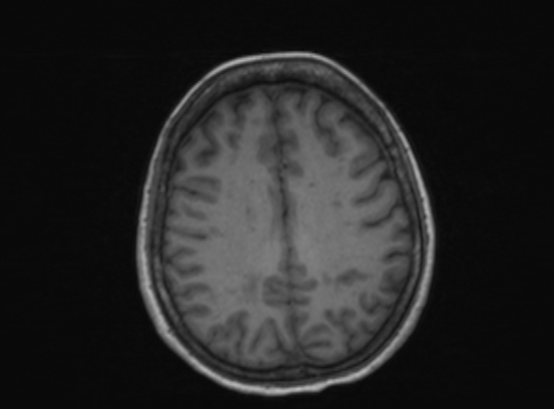 File:Bilateral PCA territory infarction - different ages (Radiopaedia 46200-51784 Axial T1 189).jpg
