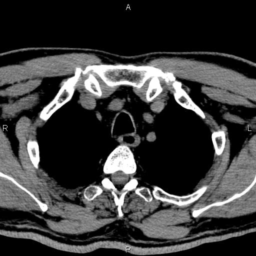 Bilateral Warthin tumors (Radiopaedia 84034-99263 Axial non-contrast 66).jpg