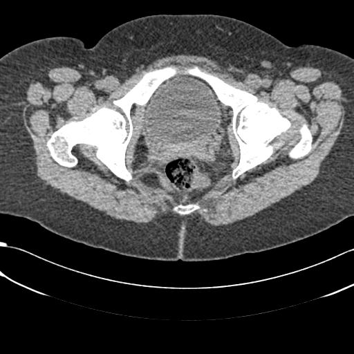 File:Bilateral acetabular protrusion with pincer type femoro-acetabular impingement (Radiopaedia 30134-30733 AXIAL SOFT THIN 53).jpg