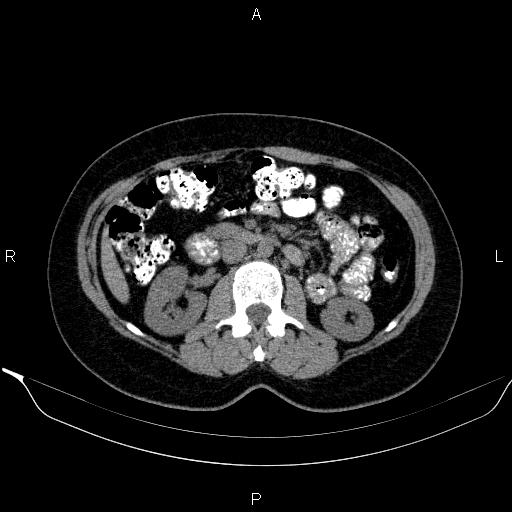 Bilateral adrenal myelolipoma (Radiopaedia 63058-71535 Axial non-contrast 78).jpg