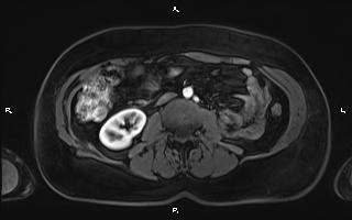 Bilateral adrenal myelolipoma (Radiopaedia 63058-71537 Axial T1 C+ fat sat 60).jpg