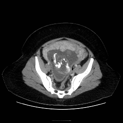 Bilateral adrenal thrombosis (Radiopaedia 58182-65256 A 63).jpg