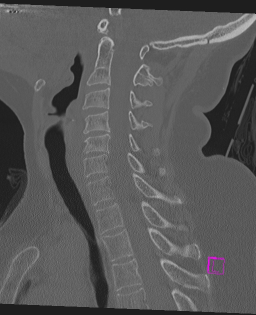 Bilateral atlanto-occipital assimilation (Radiopaedia 28350-28603 Sagittal bone window 43).jpg
