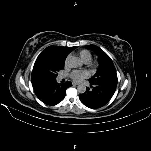 File:Bilateral benign adrenal adenomas (Radiopaedia 86912-103124 Axial non-contrast 2).jpg