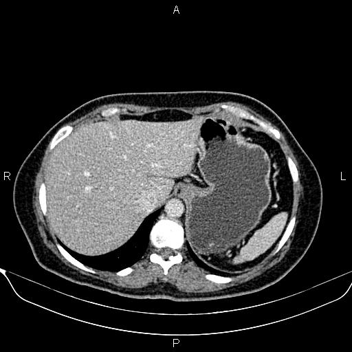 Bilateral benign adrenal adenomas (Radiopaedia 86912-103124 B 23).jpg