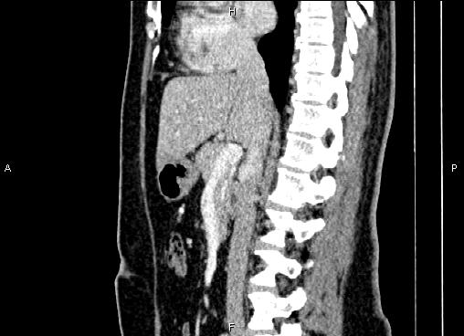 Bilateral benign adrenal adenomas (Radiopaedia 86912-103124 E 46).jpg