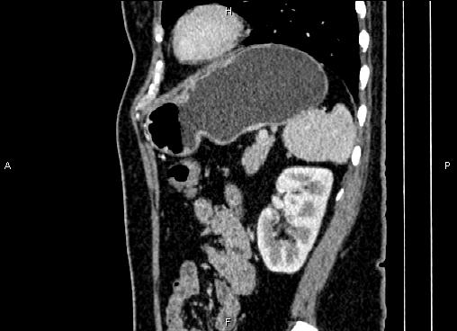 Bilateral benign adrenal adenomas (Radiopaedia 86912-103124 E 74).jpg