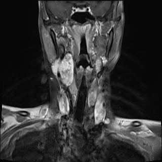 File:Bilateral carotid body tumors and right jugular paraganglioma (Radiopaedia 20024-20060 None 1).jpg