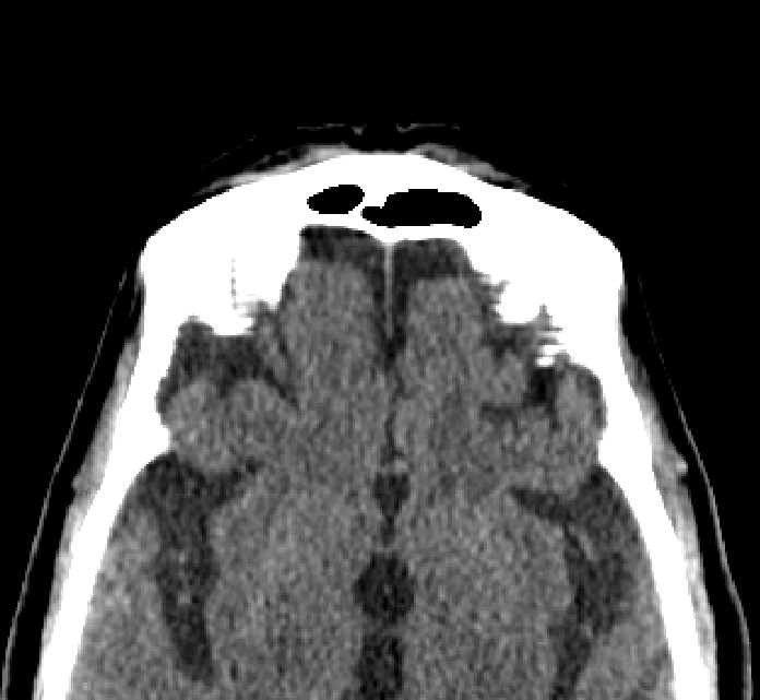 Bilateral ectopia lentis (Radiopaedia 89889-107013 Axial non-contrast 2).jpg