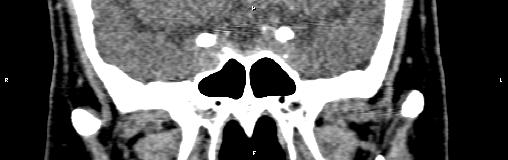 File:Bilateral enlargement of lacrimal glands - sarcoidosis (Radiopaedia 62627-70921 Coronal non-contrast 25).jpg