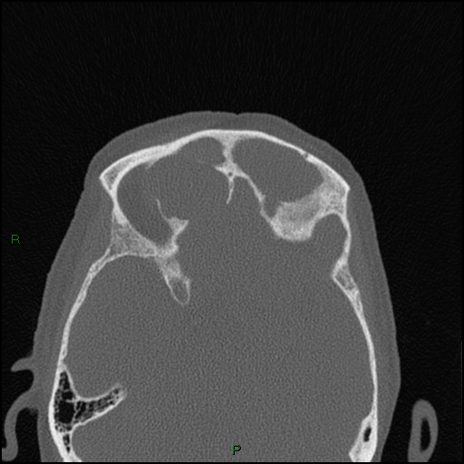 Bilateral frontal mucoceles (Radiopaedia 82352-96454 Axial bone window 113).jpg