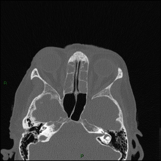 File:Bilateral frontal mucoceles (Radiopaedia 82352-96454 Axial bone window 142).jpg