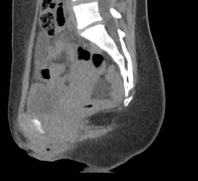 Bilateral mature cystic ovarian teratoma (Radiopaedia 88821-105592 D 30).jpg