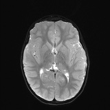 File:Bilateral mesial temporal polymicrogyria (Radiopaedia 76456-88181 Axial DWI 13).jpg