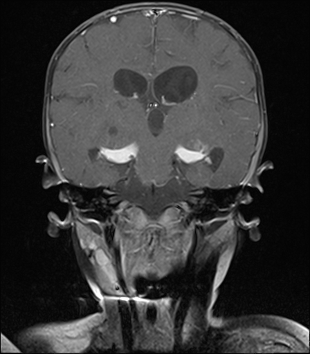 File:Bilateral optic pathway gliomas (Radiopaedia 40013-42514 D 14).jpg