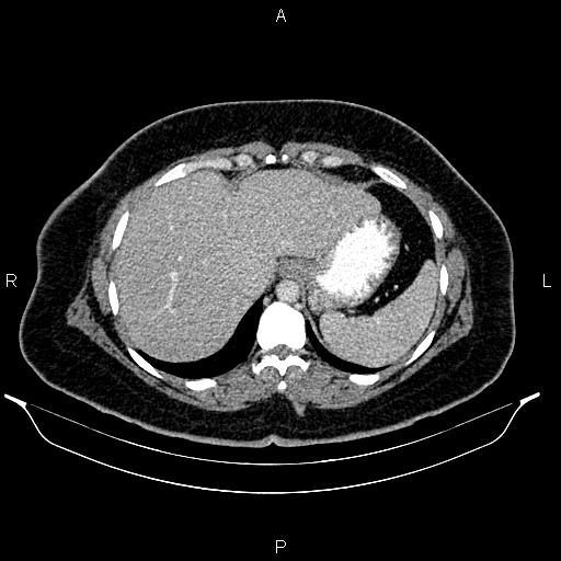 Bilateral ovarian dermoid cysts (Radiopaedia 85785-101603 A 20).jpg