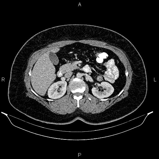 Bilateral ovarian dermoid cysts (Radiopaedia 85785-101603 A 43).jpg