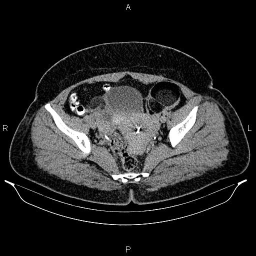 File:Bilateral ovarian dermoid cysts (Radiopaedia 85785-101603 Axial C+ delayed 70).jpg