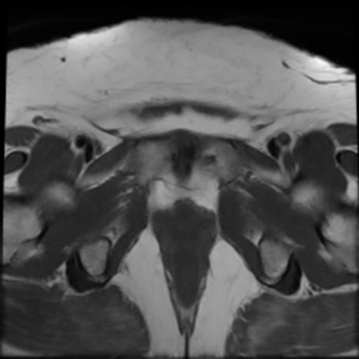 File:Bilateral ovarian dermoid cysts (Radiopaedia 90152-107338 Axial T1 20).jpg