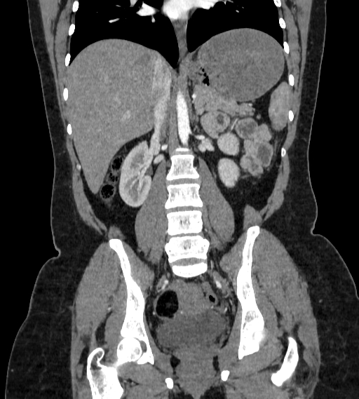 Bilateral ovarian mature cystic teratomas (Radiopaedia 79373-92457 B 48).jpg