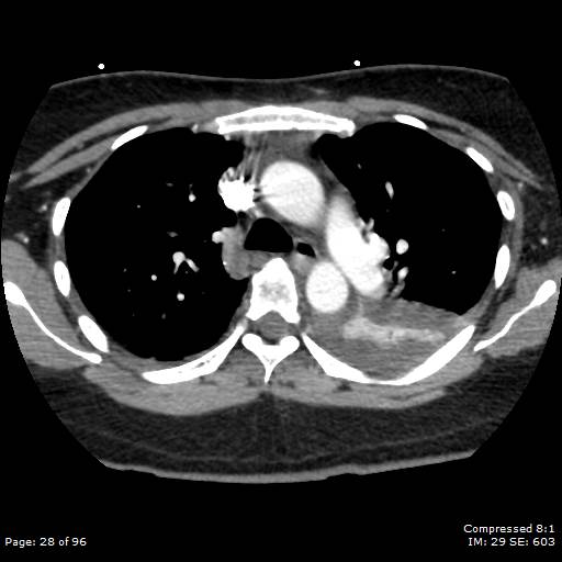 Bilateral pulmonary emboli with Hampton hump sign (Radiopaedia 54070-60246 Axial C+ CTPA 25).jpg