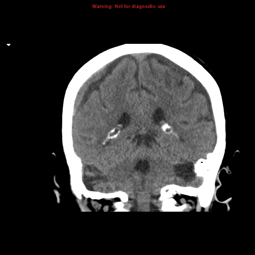 File:Bilateral subdural hemorrhage (Radiopaedia 8819-9620 Coronal non-contrast 13).jpg