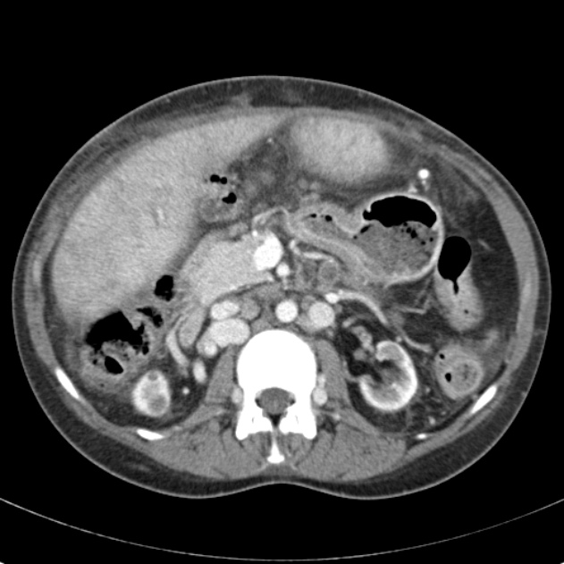Biliary necrosis - liver transplant (Radiopaedia 21876-21846 B 31).jpg