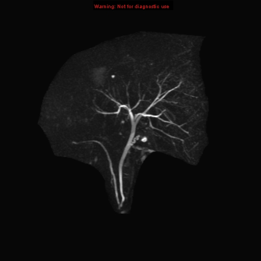 File:Biliary tree anatomical variant - biliary trifurcation (Radiopaedia 12531-12750 Coronal 3D MRCP 20).jpg