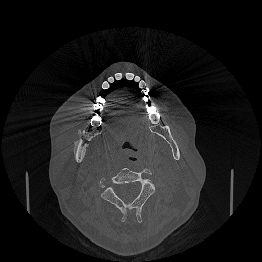 File:Bisphosphonate-related osteonecrosis of the jaw (Radiopaedia 71324-81642 Axial bone window 78).jpg