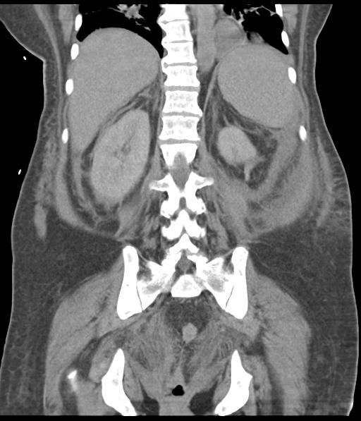 Bladder rupture post renal biopsy (Radiopaedia 30863-31572 Coronal non-contrast 43).jpg