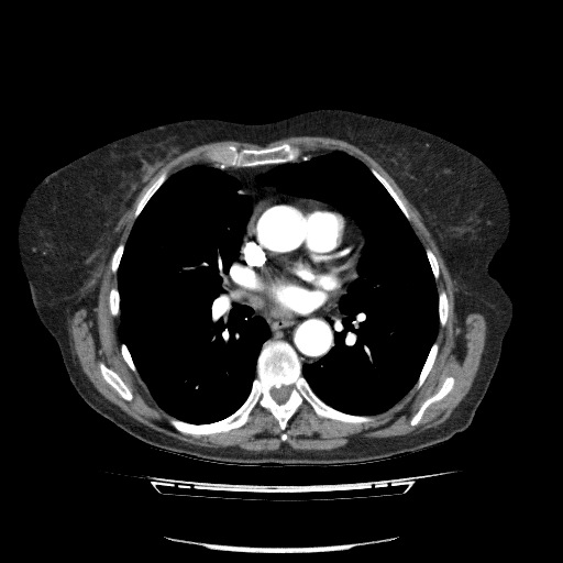 File:Bladder tumor detected on trauma CT (Radiopaedia 51809-57609 A 52).jpg