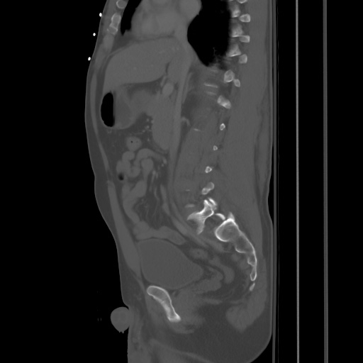 File:Blunt abdominal trauma with solid organ and musculoskelatal injury with active extravasation (Radiopaedia 68364-77895 Sagittal bone window 42).jpg