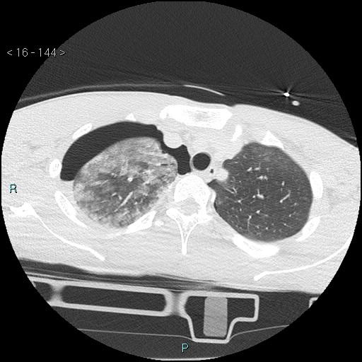 Blunt chest trauma (Swiss cheese sign) (Radiopaedia 38519-40618 Axial lung window 13).jpg