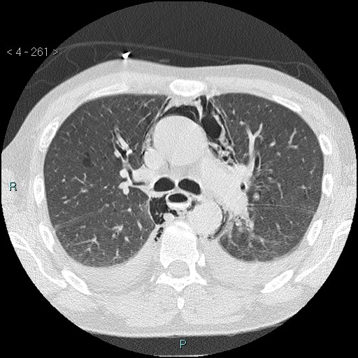 Boerhaave syndrome (Radiopaedia 27683-27897 lung window 19).jpg