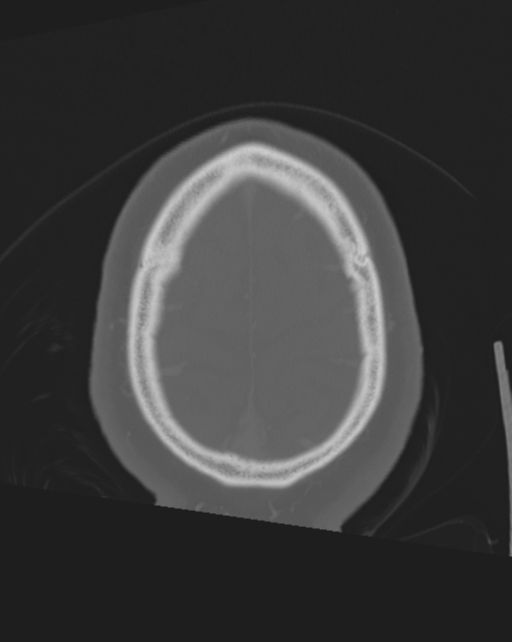Bone-anchored hearing aid (Radiopaedia 38708-40866 Axial bone window 12).png