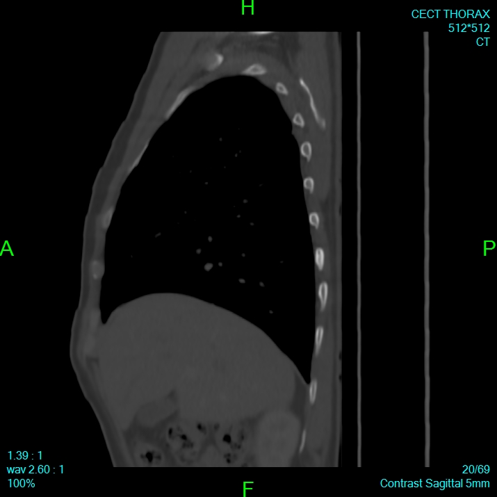 Bone metastases from lung carcinoma (Radiopaedia 54703-60937 Sagittal bone window 20).jpg