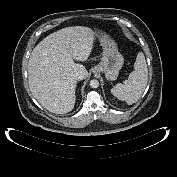 Bosniak renal cyst - type IV (Radiopaedia 24244-24518 C 56).jpg