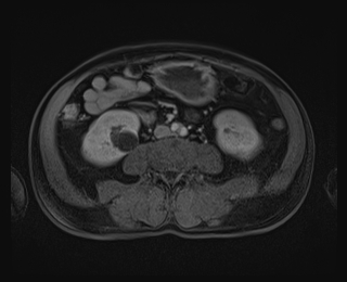 Bouveret syndrome (Radiopaedia 61017-68856 Axial T1 C+ fat sat 57).jpg