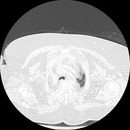 Bovine aortic arch - right internal mammary vein drains into the superior vena cava (Radiopaedia 63296-71875 Axial lung window 21).jpg