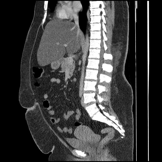Bowel and splenic infarcts in acute lymphocytic leukemia (Radiopaedia 61055-68913 C 42).jpg
