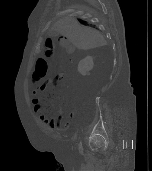 Bowel ischemia secondary to SMA occlusion with extensive portomesenteric venous gas (Radiopaedia 54656-60871 Sagittal bone window 87).jpg