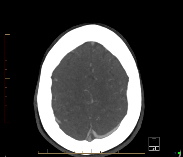 Brachiocephalic trunk stenosis (Radiopaedia 87242-103519 A 11).jpg