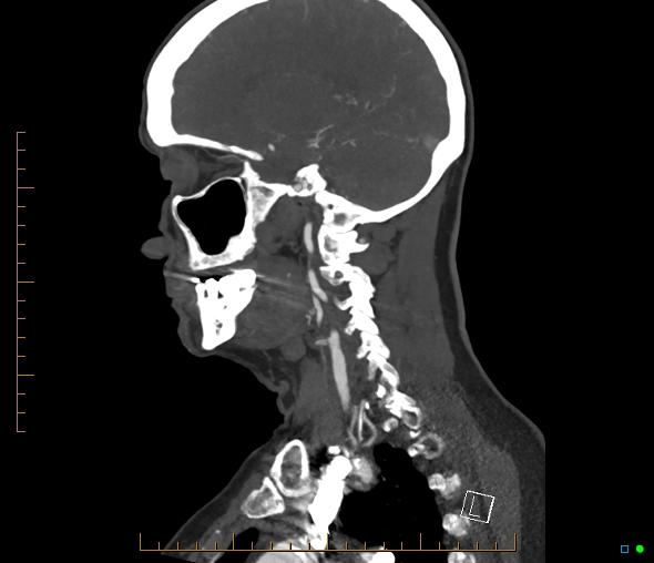 Brachiocephalic trunk stenosis (Radiopaedia 87242-103519 C 43).jpg