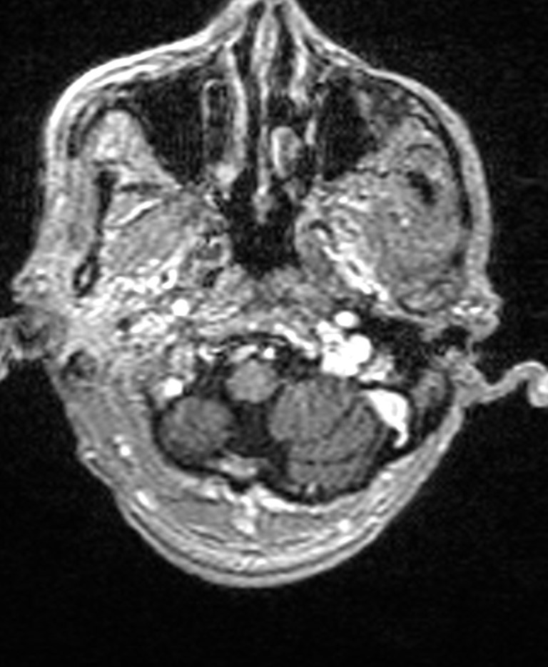 Brain abscess with dual rim sign (Radiopaedia 87566-103938 Axial T1 C+ 26).jpg