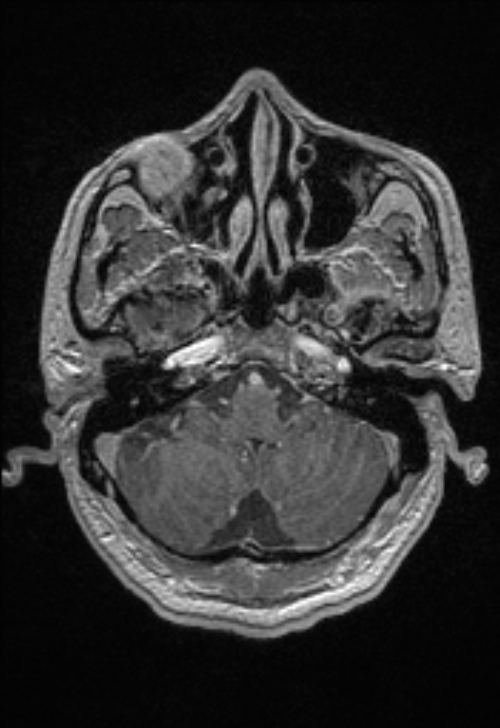 Brain abscess with ventriculitis (Radiopaedia 85703-101495 Axial T1 C+ 41).jpg