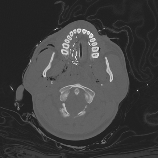 File:Brain contusions, internal carotid artery dissection and base of skull fracture (Radiopaedia 34089-35339 Axial bone window 37).png