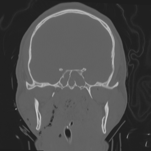 File:Brain contusions, internal carotid artery dissection and base of skull fracture (Radiopaedia 34089-35339 Coronal bone window 32).png