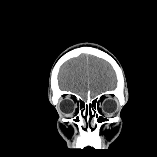 Brain death (Radiopaedia 78597-91360 Coronal non-contrast 14).jpg